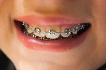 What to Do When a Bracket Comes Loose: Quick Fixes for Orthodontic Emergencies