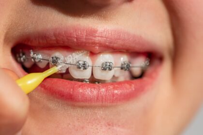 Bright Smiles with Braces: Keeping Teeth White During Orthodontic Treatment